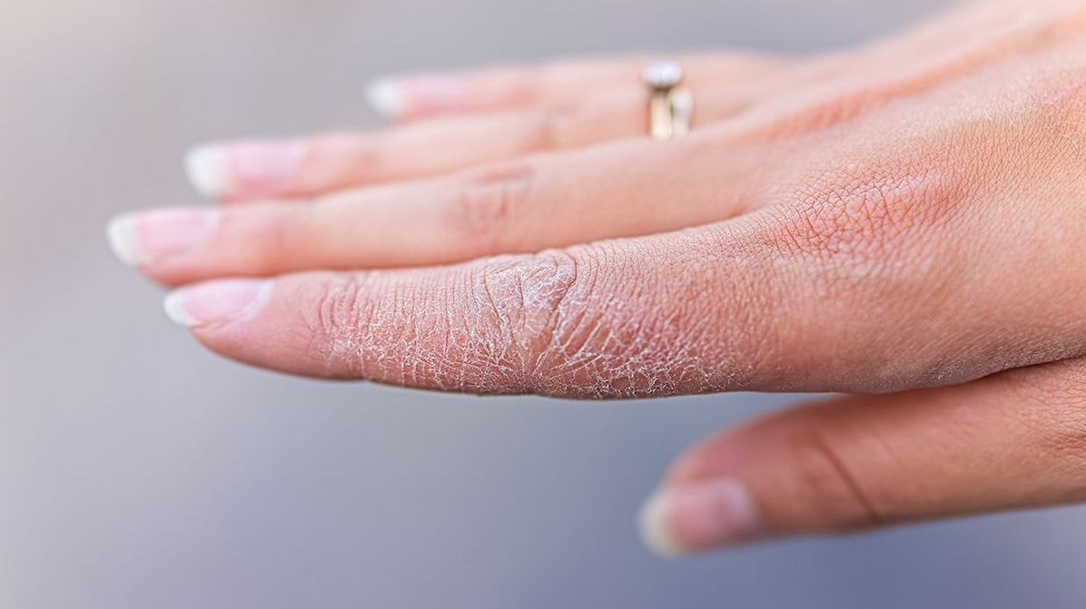 Причины сухой кожи: как справиться с дискомфортом